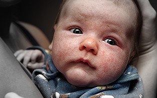 Eczema, or atopic dermatitis