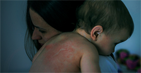 What is Eczema & How These Moms Helped Their Kids Get Rid of It